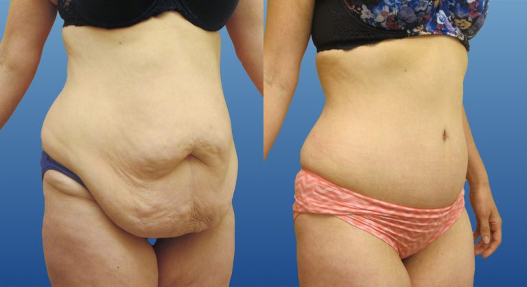 Abdominoplasty