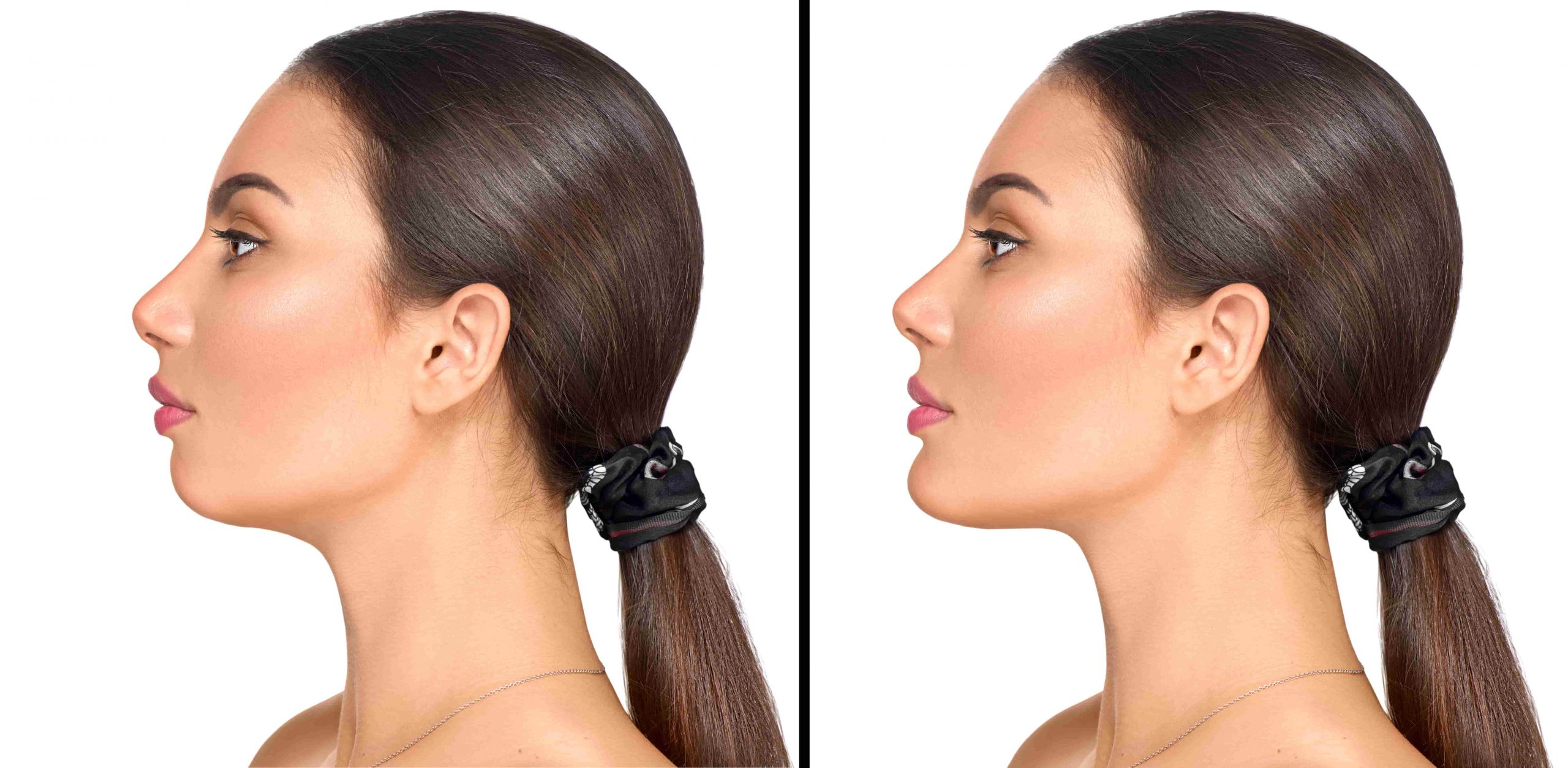 Chin Augmentation
