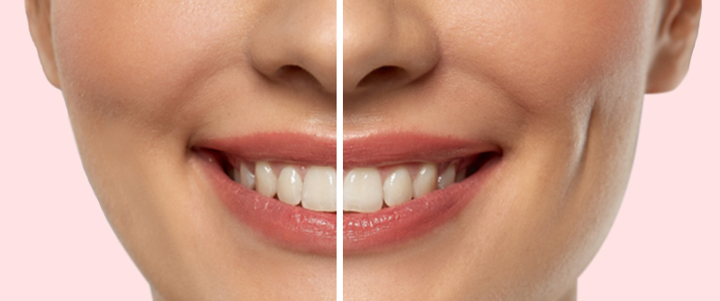 Dimple Surgery