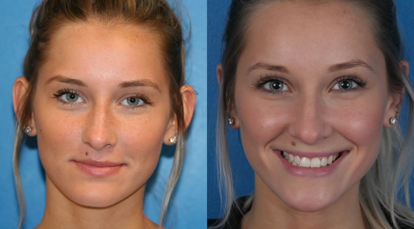 Ear Surgery