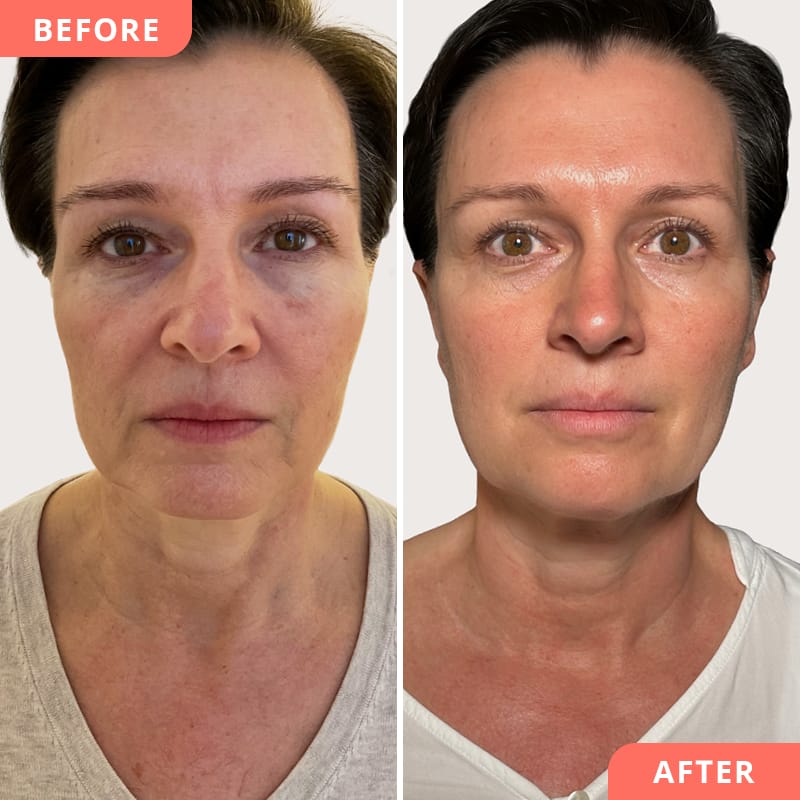 Face Lift