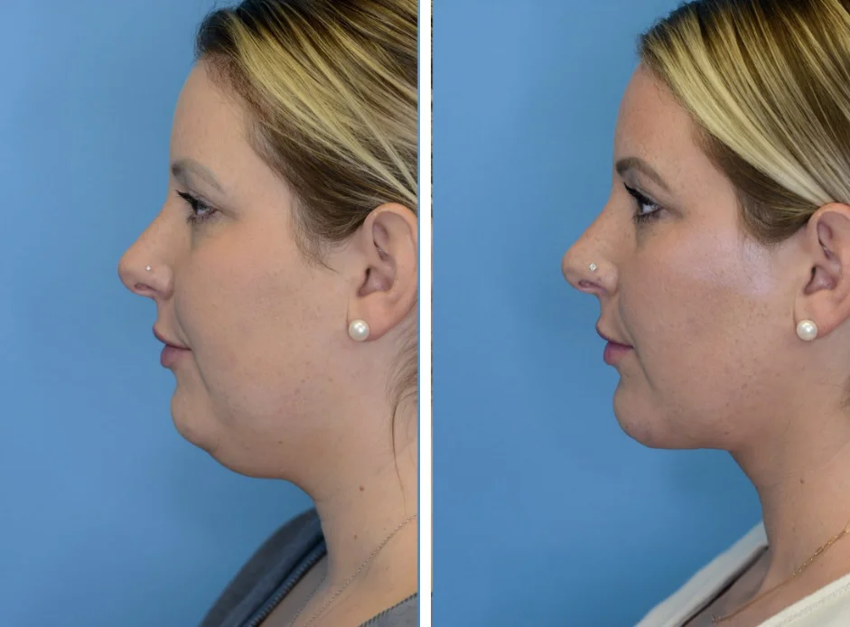 Neck lift
